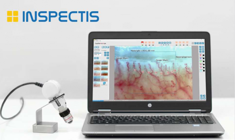 CAPILAROSCOP MEDICAL VIDEO CU SOFTWARE (SUEDIA)