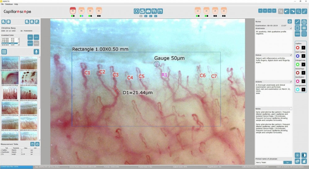 CAPILAROSCOP MEDICAL VIDEO CU SOFTWARE (SUEDIA)