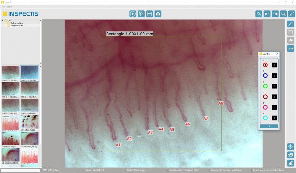 CAPILAROSCOP MEDICAL VIDEO CU SOFTWARE (SUEDIA)